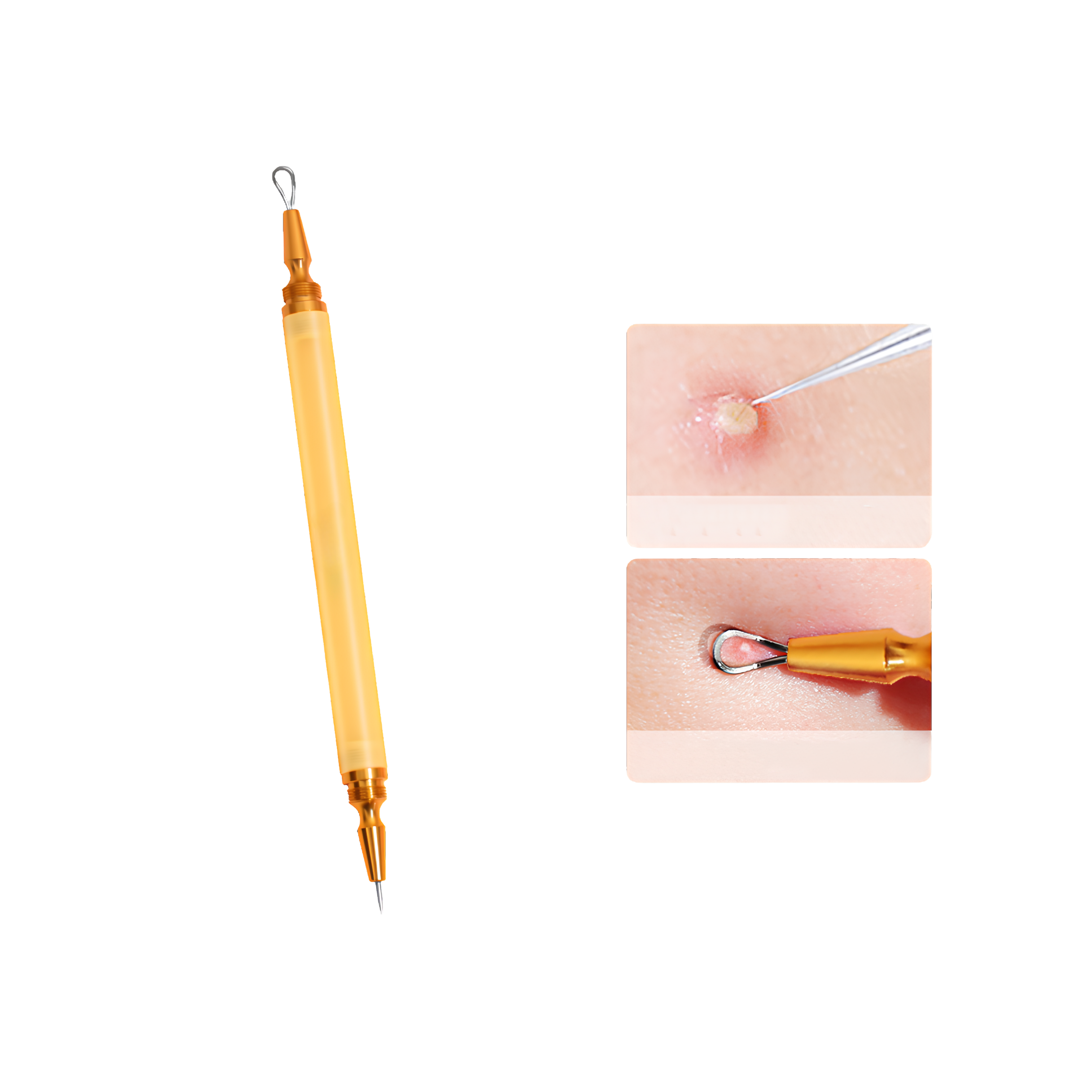 AcneMate Acne Lancet Tool