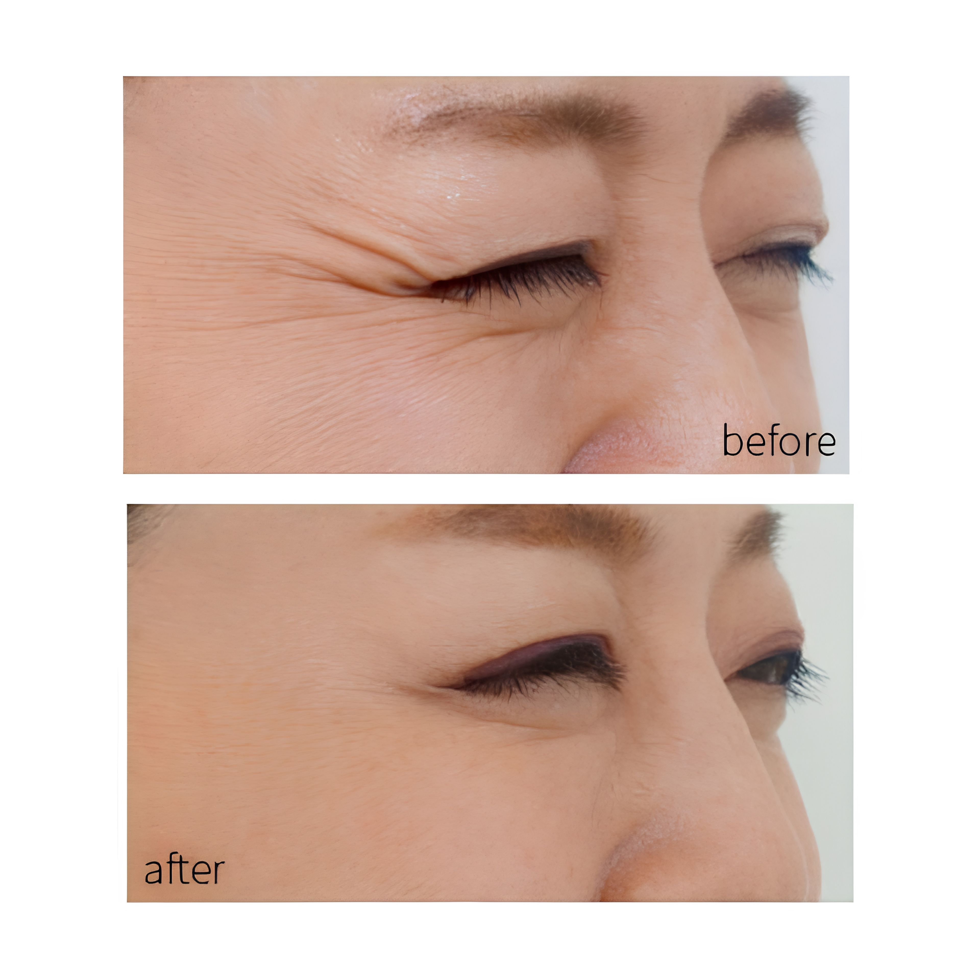 AcneMate LED ClearSkin Mask