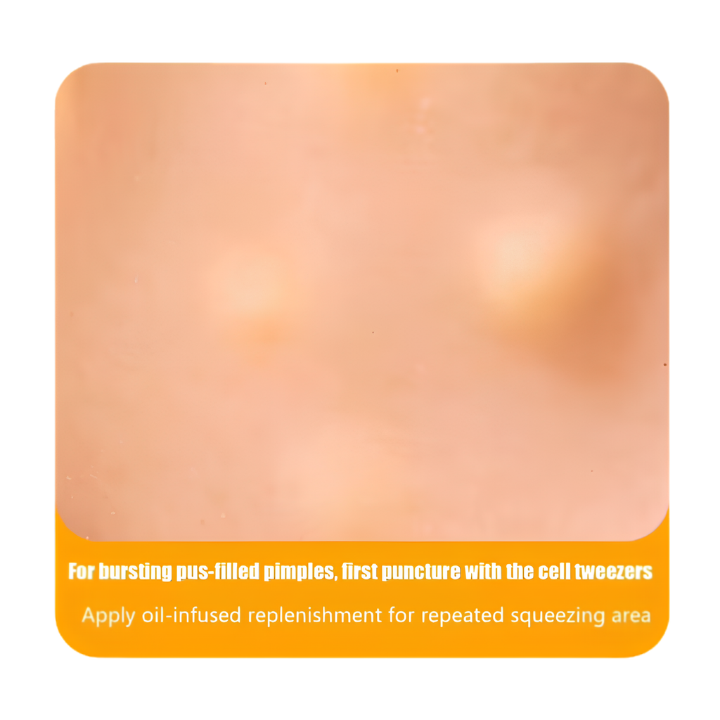 AcneMate Pop & Squeeze Head